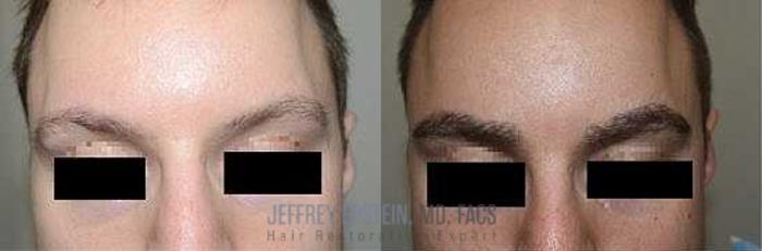 Before & After Eyebrow Transplant Case 315 View 1 View in Miami, FL