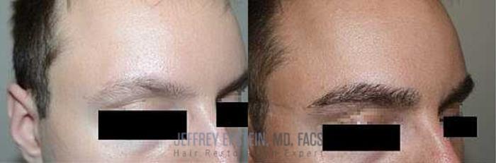 Before & After Eyebrow Transplant Case 315 View 2 View in Miami, FL