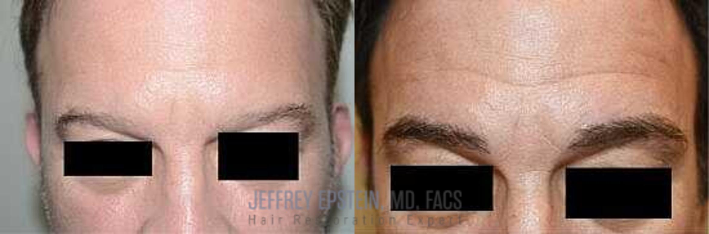 Before & After Eyebrow Transplant Case 316 View 1 View in Miami, FL
