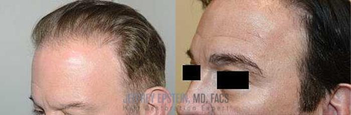 Before & After Eyebrow Transplant Case 316 View 2 View in Miami, FL