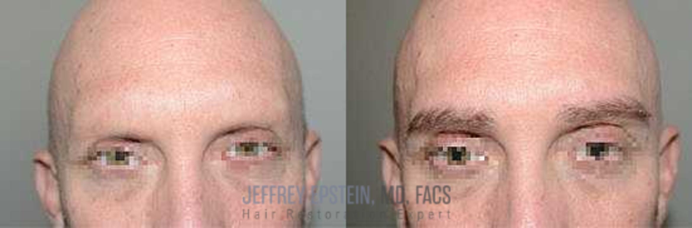 Before & After Eyebrow Transplant Case 317 View 1 View in Miami, FL