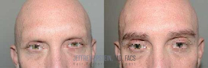 Before & After Eyebrow Transplant Case 317 View 1 View in Miami, FL