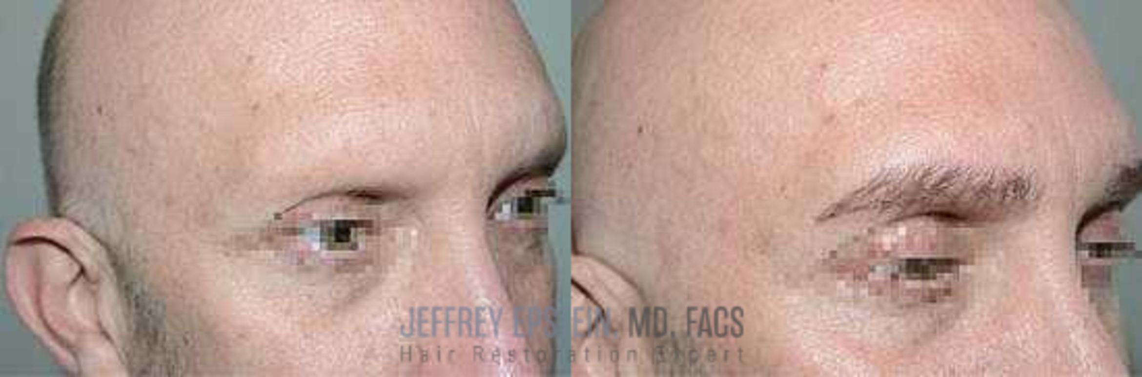 Before & After Eyebrow Transplant Case 317 View 2 View in Miami, FL