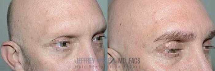 Before & After Eyebrow Transplant Case 317 View 2 View in Miami, FL