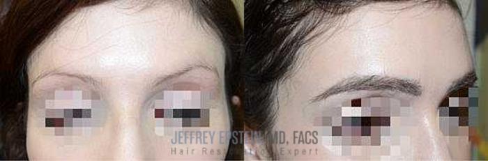 Before & After Eyebrow Transplant Case 318 View 2 View in Miami, FL