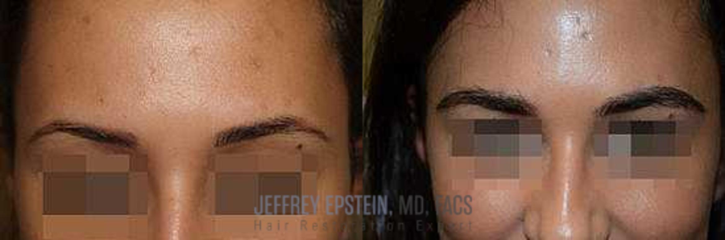 Before & After Eyebrow Transplant Case 320 View 1 View in Miami, FL