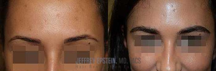 Before & After Eyebrow Transplant Case 320 View 1 View in Miami, FL