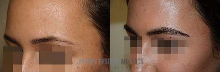 Before & After Eyebrow Transplant Case 320 View 2 View in Miami, FL