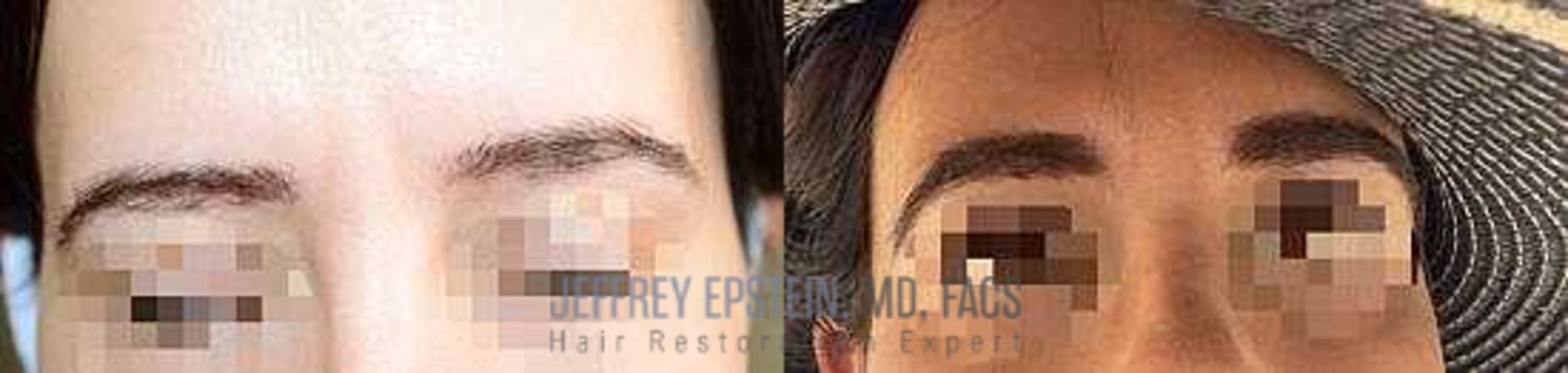 Before & After Eyebrow Transplant Case 321 View 1 View in Miami, FL