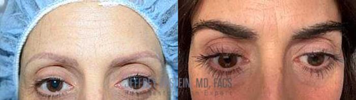 Before & After Eyebrow Transplant Case 322 View 1 View in Miami, FL