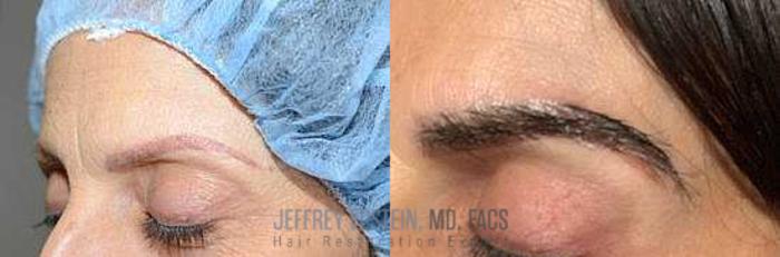 Before & After Eyebrow Transplant Case 322 View 2 View in Miami, FL