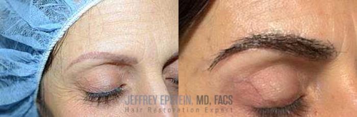 Before & After Eyebrow Transplant Case 322 View 3 View in Miami, FL