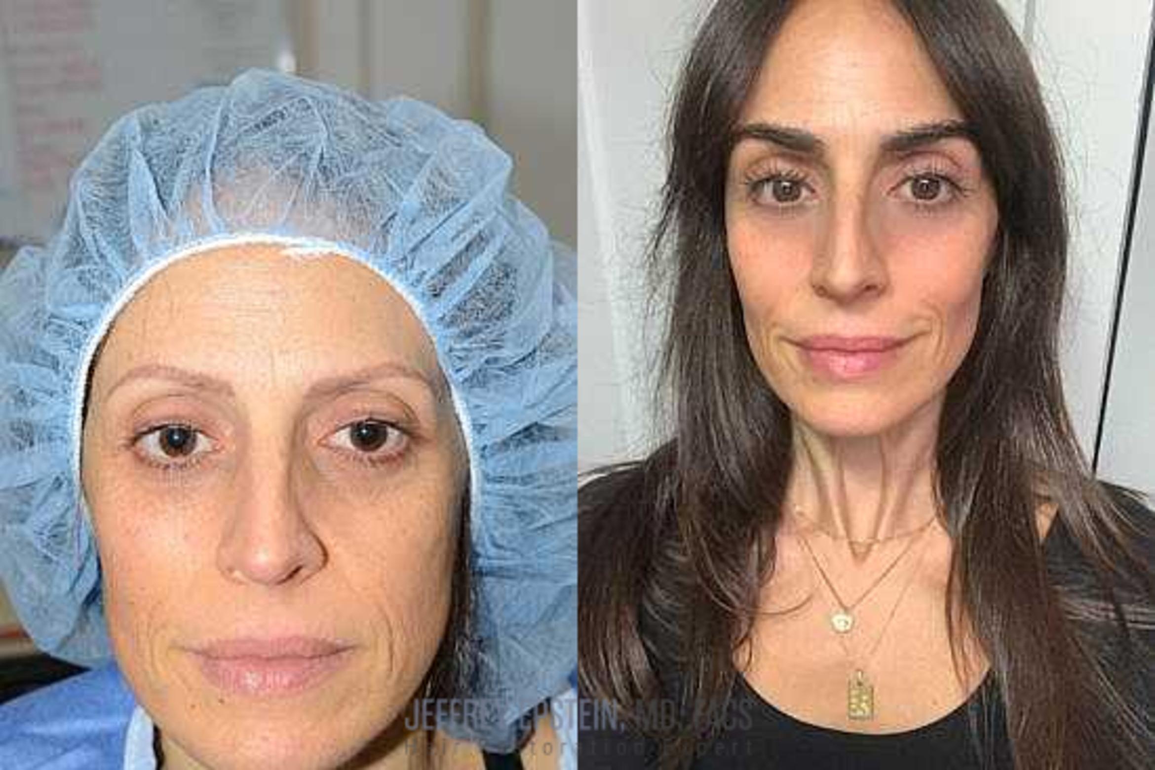 Before & After Eyebrow Transplant Case 322 View 4 View in Miami, FL