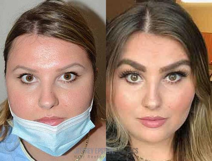 Before & After Eyebrow Transplant Case 323 View 1 View in Miami, FL