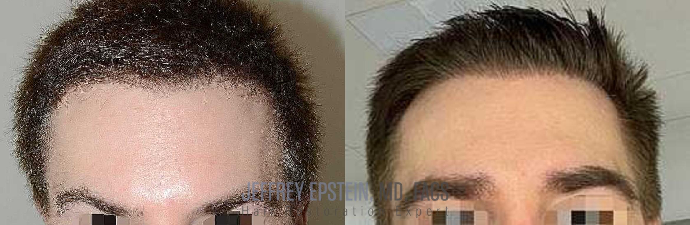 Before & After Eyebrow Transplant Case 324 View 1 View in Miami, FL