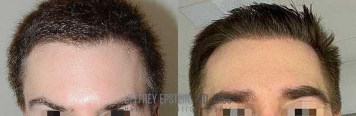 Before & After Eyebrow Transplant Case 324 View 1 View in Miami, FL