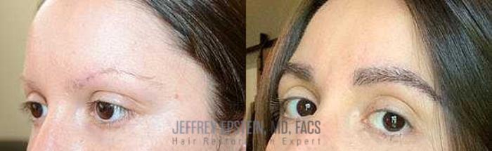 Before & After Eyebrow Transplant Case 325 View 1 View in Miami, FL