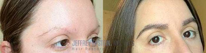 Before & After Eyebrow Transplant Case 325 View 2 View in Miami, FL