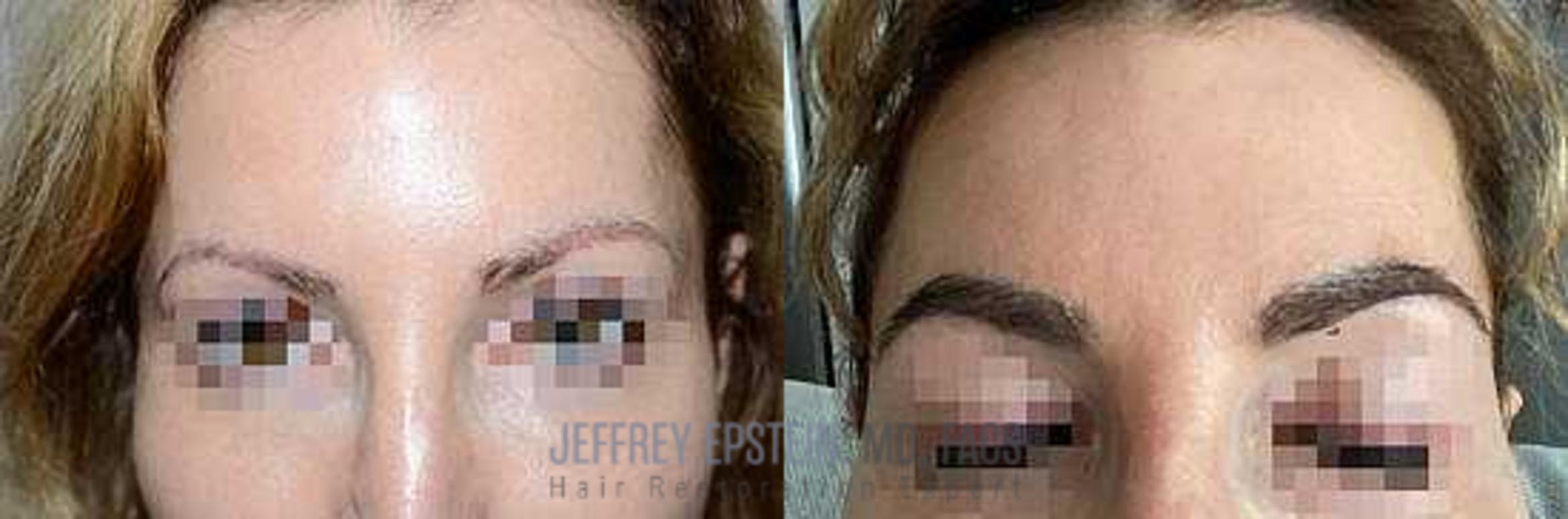 Before & After Eyebrow Transplant Case 326 View 1 View in Miami, FL