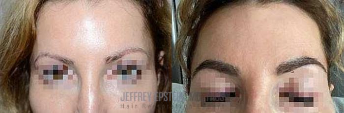 Before & After Eyebrow Transplant Case 326 View 1 View in Miami, FL