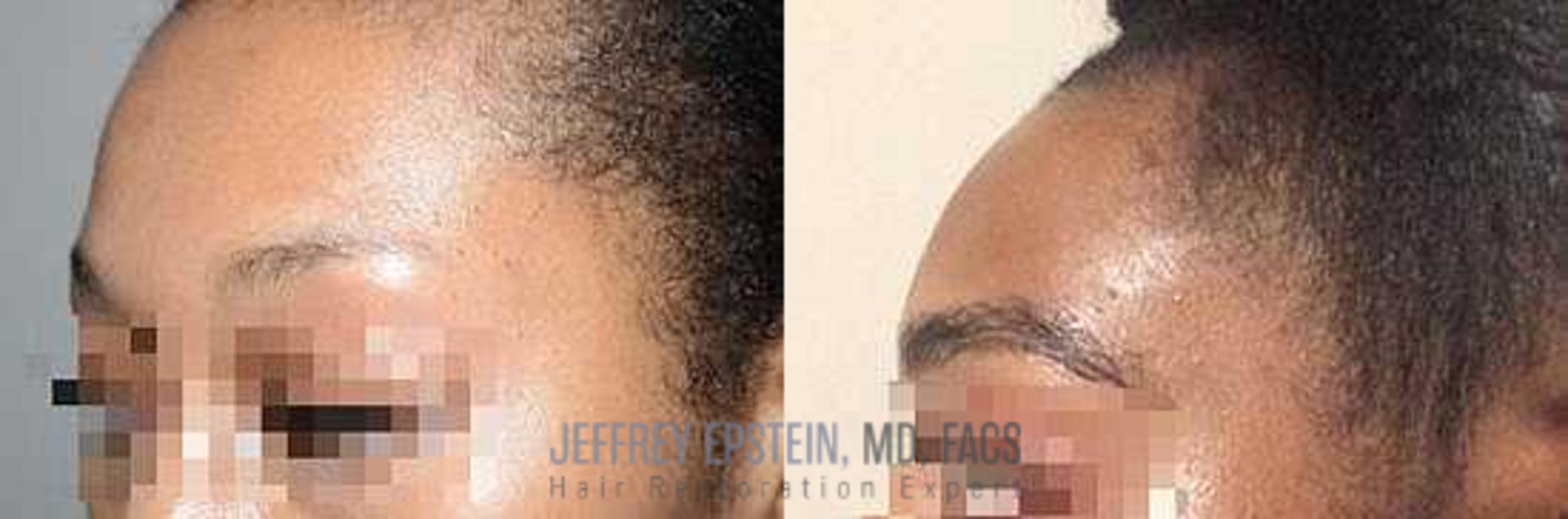 Before & After Eyebrow Transplant Case 327 View 1 View in Miami, FL