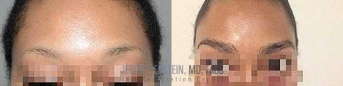 Before & After Eyebrow Transplant Case 327 View 2 View in Miami, FL