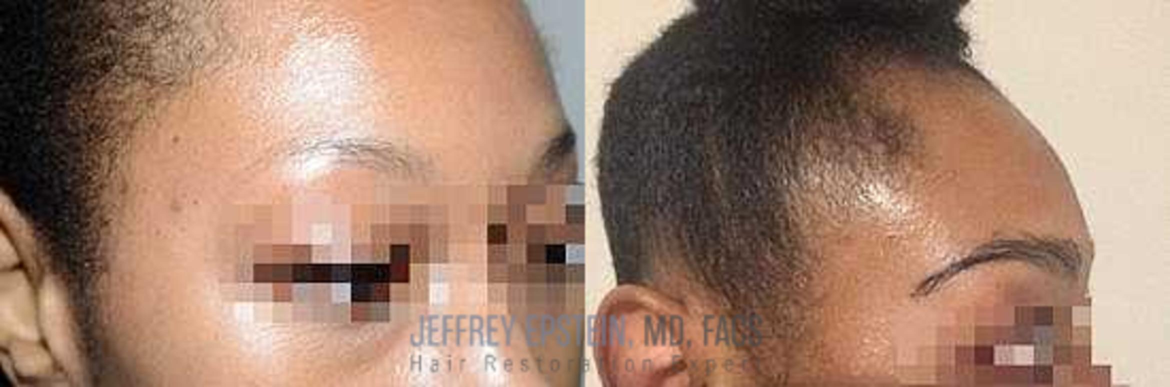 Before & After Eyebrow Transplant Case 327 View 3 View in Miami, FL