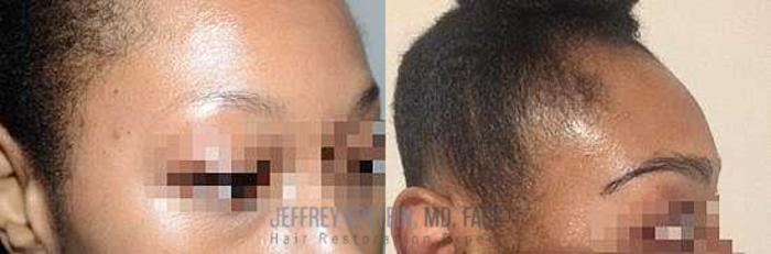 Before & After Eyebrow Transplant Case 327 View 3 View in Miami, FL