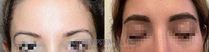 Before & After Eyebrow Transplant Case 328 View 1 View in Miami, FL