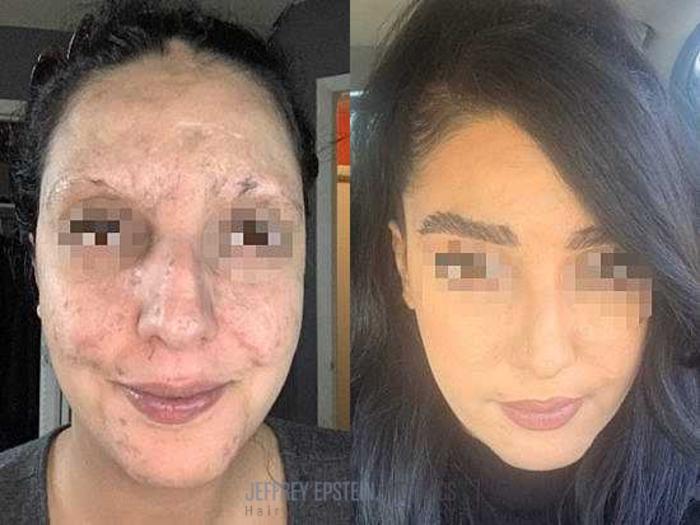 Before & After Eyebrow Transplant Case 329 View 1 View in Miami, FL
