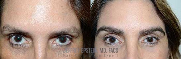 Before & After Eyebrow Transplant Case 330 View 1 View in Miami, FL