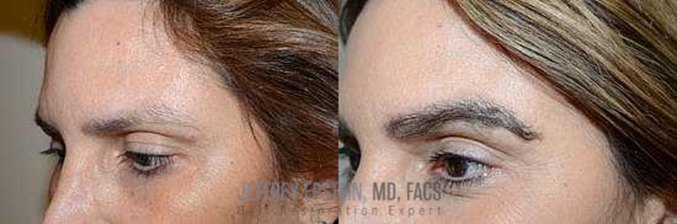 Before & After Eyebrow Transplant Case 330 View 2 View in Miami, FL