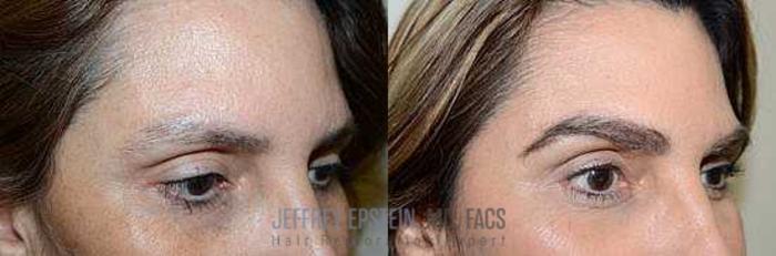 Before & After Eyebrow Transplant Case 330 View 3 View in Miami, FL