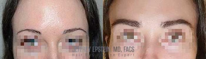 Before & After Eyebrow Transplant Case 332 View 1 View in Miami, FL