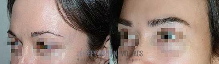 Before & After Eyebrow Transplant Case 332 View 2 View in Miami, FL