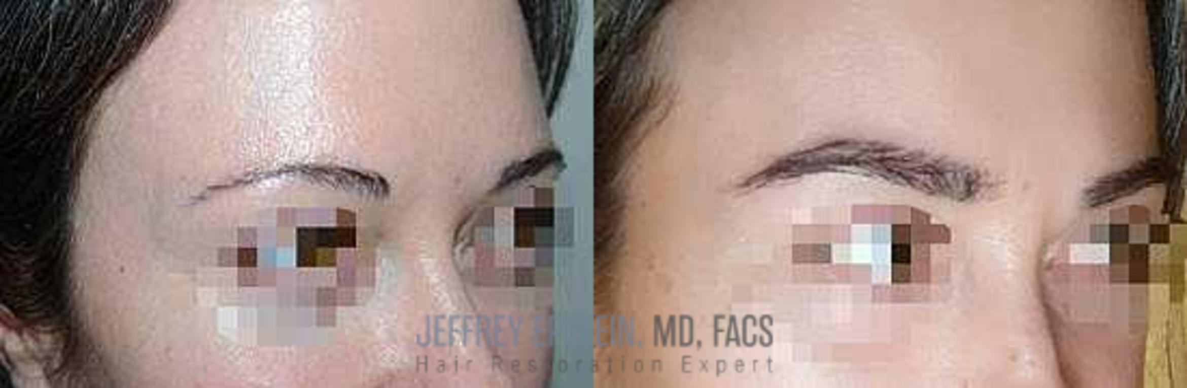 Before & After Eyebrow Transplant Case 332 View 3 View in Miami, FL