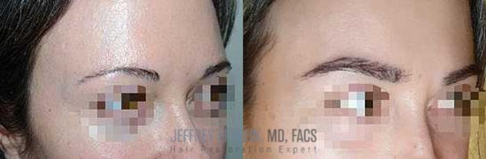 Before & After Eyebrow Transplant Case 332 View 3 View in Miami, FL
