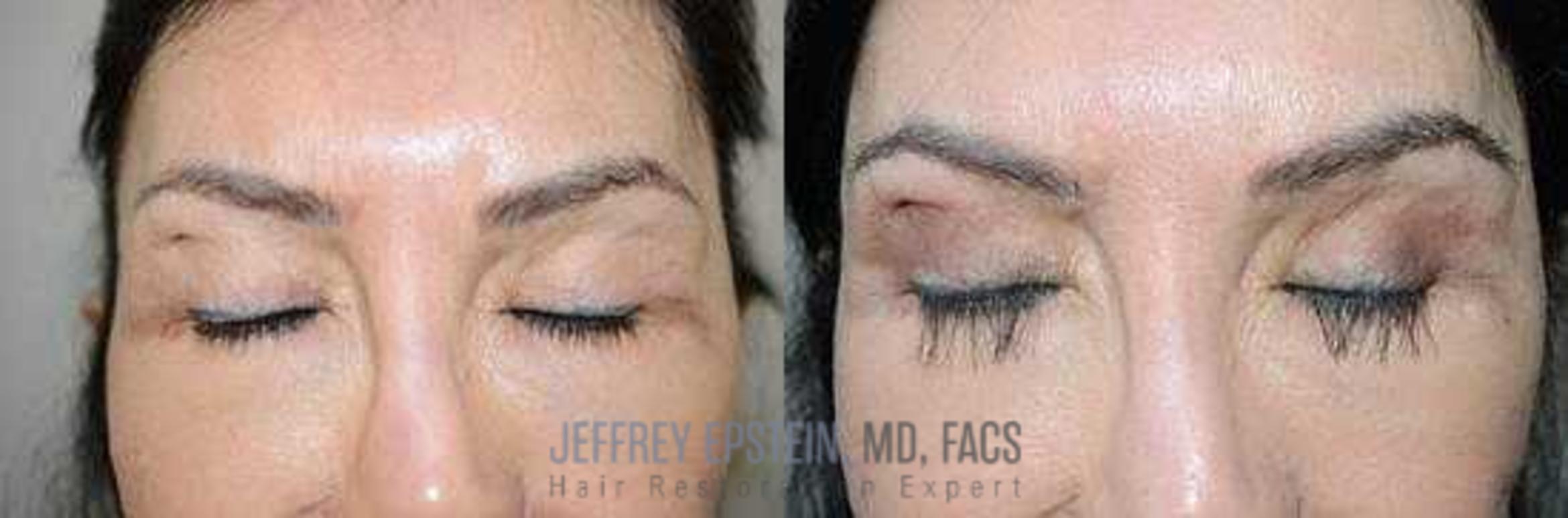 Before & After Eyebrow Transplant Case 333 View 1 View in Miami, FL