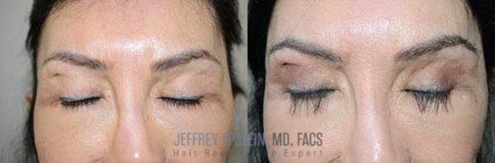 Before & After Eyebrow Transplant Case 333 View 1 View in Miami, FL