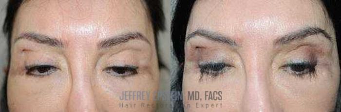 Before & After Eyebrow Transplant Case 333 View 2 View in Miami, FL
