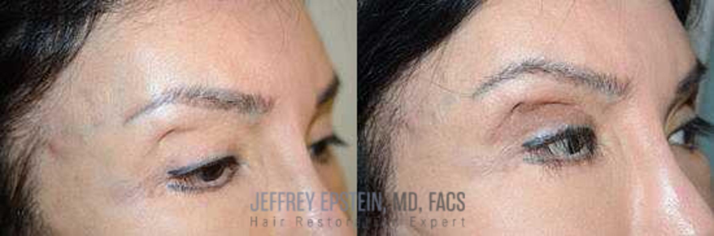 Before & After Eyebrow Transplant Case 333 View 3 View in Miami, FL