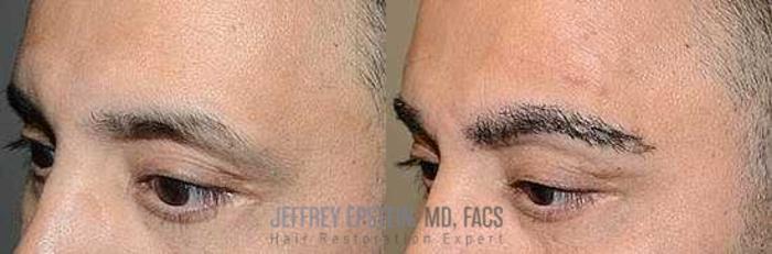 Before & After Eyebrow Transplant Case 334 View 2 View in Miami, FL