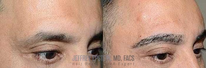 Before & After Eyebrow Transplant Case 334 View 3 View in Miami, FL