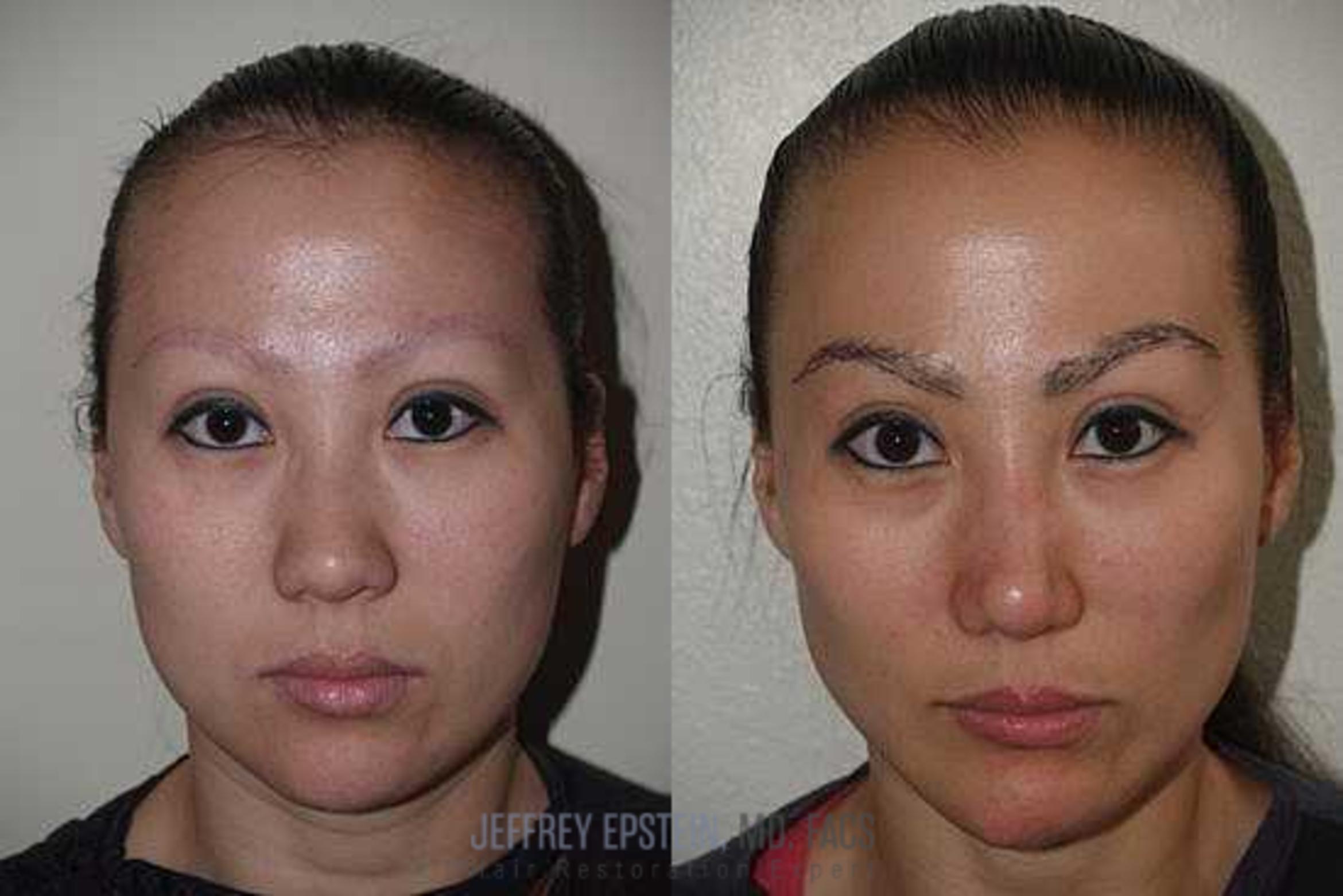 Before & After Eyebrow Transplant Case 335 View 1 View in Miami, FL