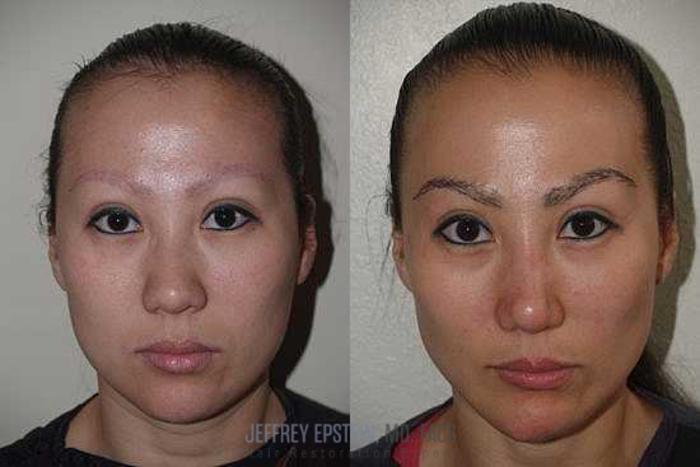 Before & After Eyebrow Transplant Case 335 View 1 View in Miami, FL