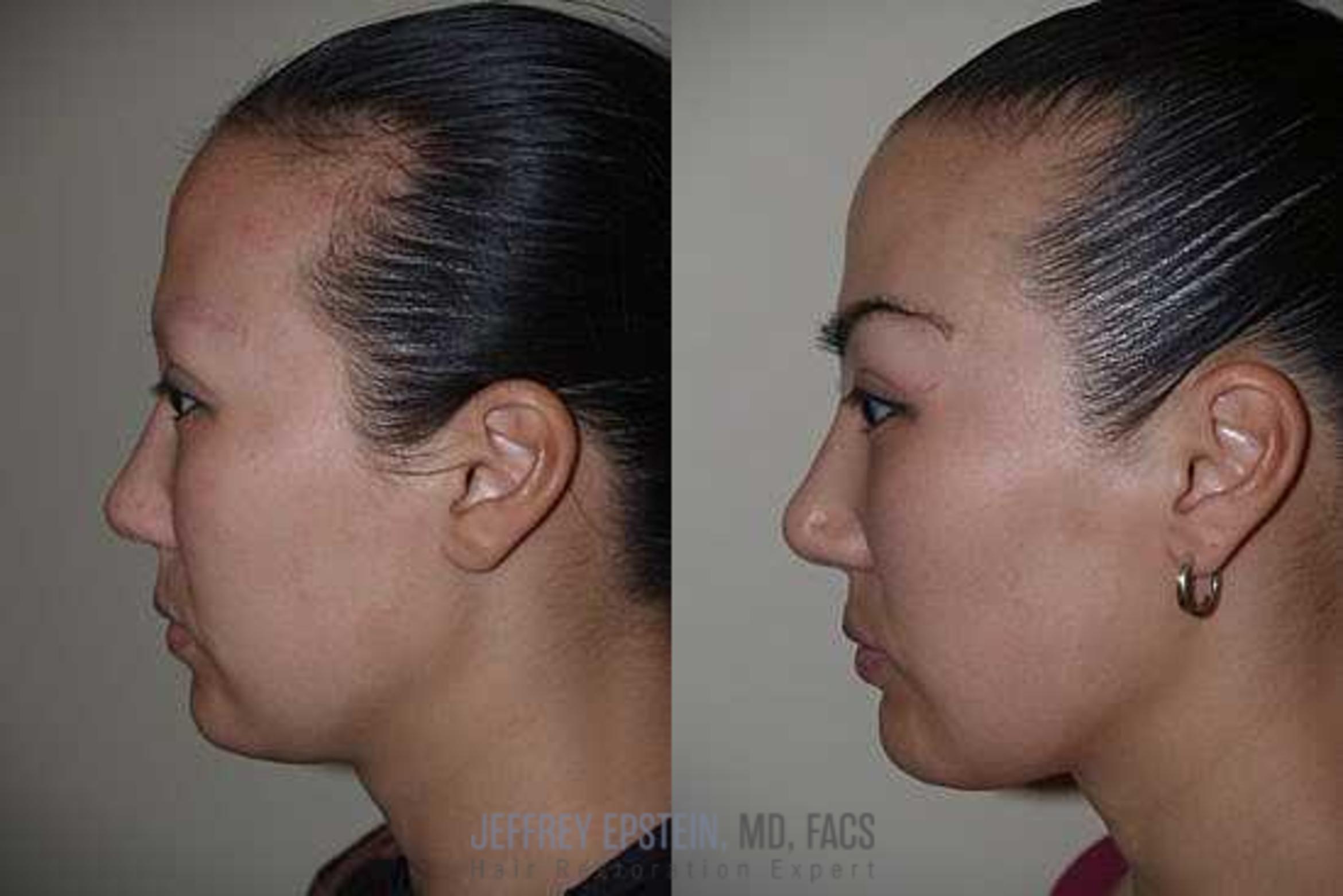 Before & After Eyebrow Transplant Case 335 View 2 View in Miami, FL
