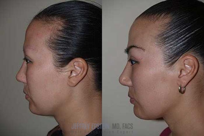 Before & After Eyebrow Transplant Case 335 View 2 View in Miami, FL