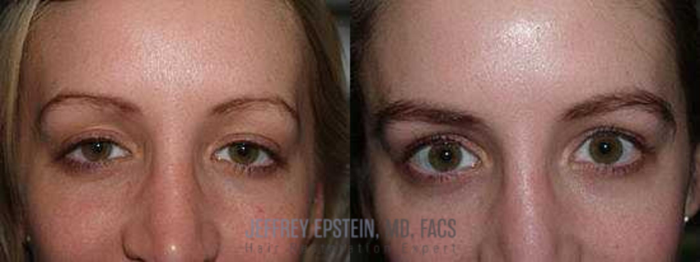 Before & After Eyebrow Transplant Case 336 View 1 View in Miami, FL