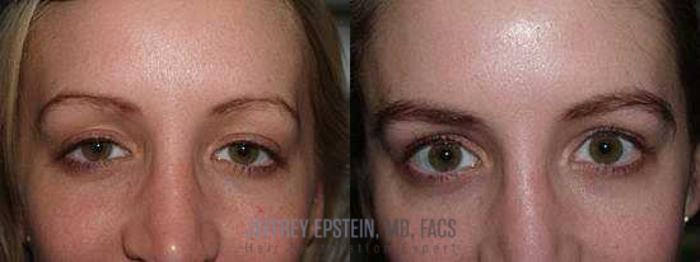 Before & After Eyebrow Transplant Case 336 View 1 View in Miami, FL