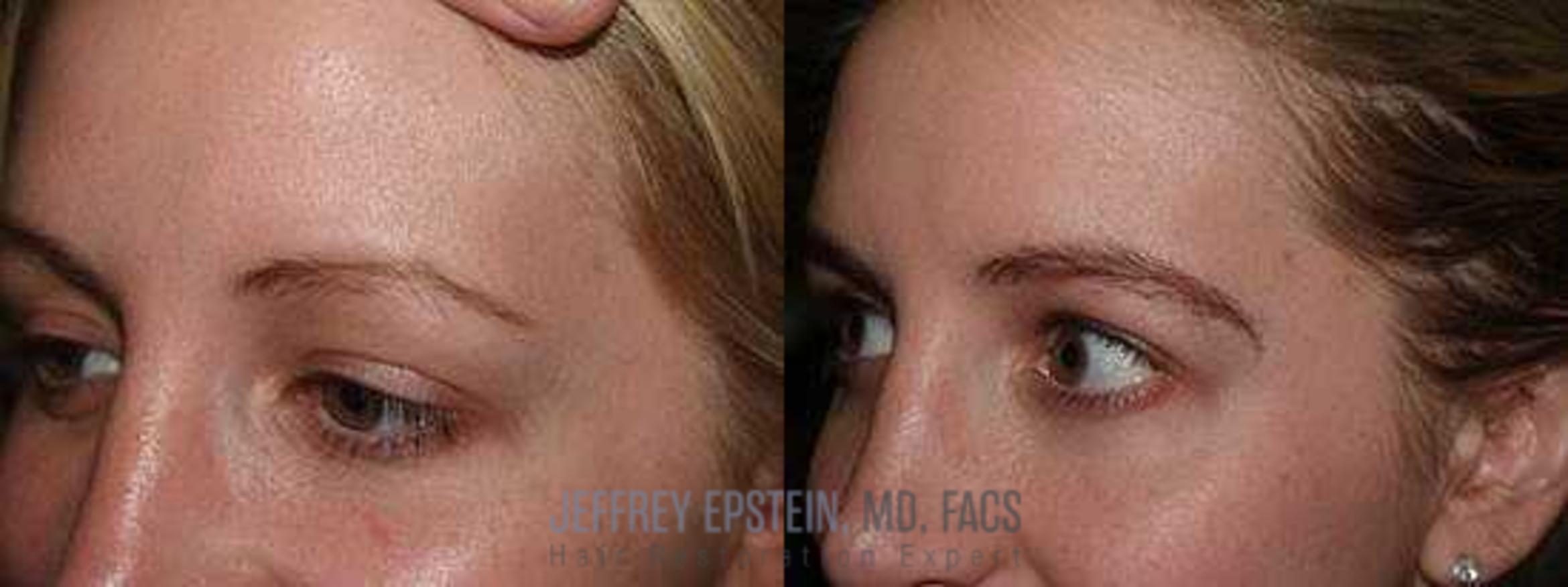 Before & After Eyebrow Transplant Case 336 View 2 View in Miami, FL